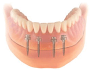 MDIミニインプラント